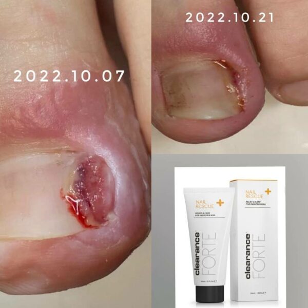 NAIL RESCUE -Clearance